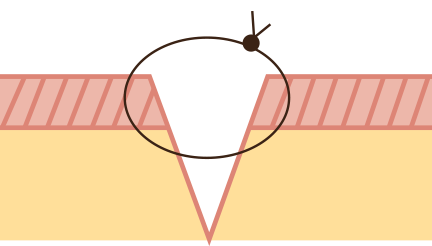 Illustration point dermique